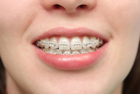 Ortodoncie - Rovnátka